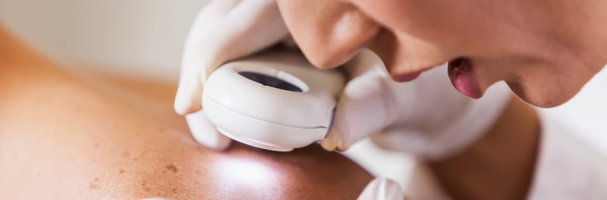 Stock photograph of models: a dermatologist in white gloves looks closely at the skin of a bare shoulder through a dermatoscope